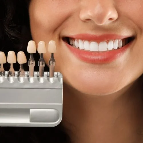 Patient smiling during porcelain veneer shade matching using a dental shade guide at Dental Art Clinic in Cambridge.