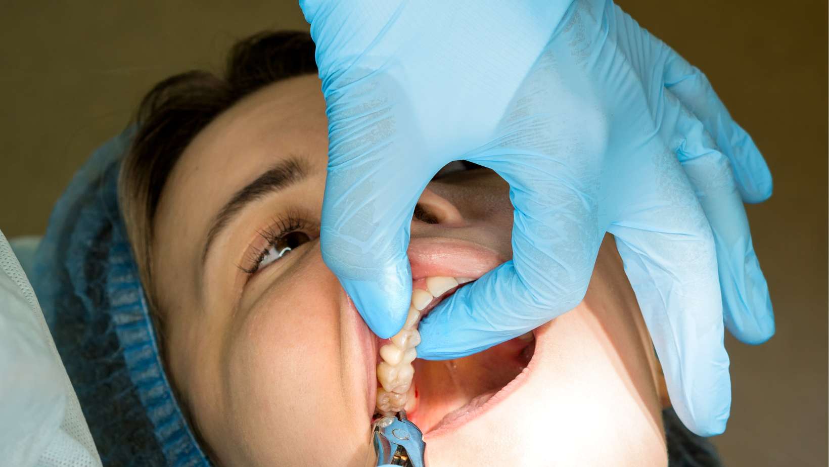 A dentist performing a wisdom tooth extraction on a patient at Dental Art Clinic in Cambridge.