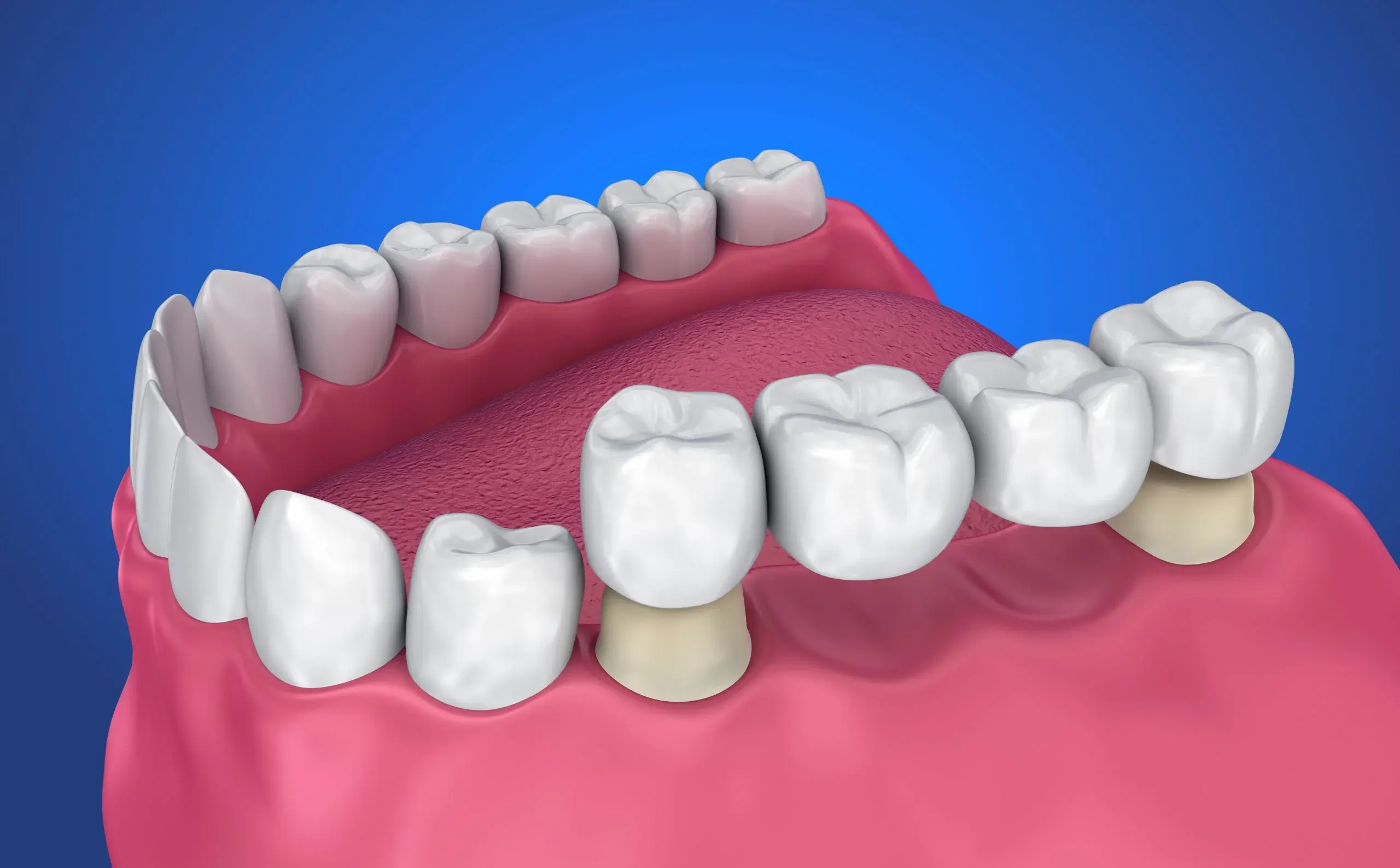Close-up of natural-looking dental Bridges on a model, showcasing cosmetic dentistry results at Dental Art Clinic in Cambridge.