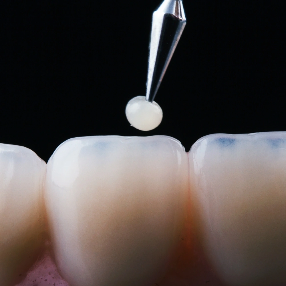 Close-up of composite bonding material being applied to a tooth at Dental Art Clinic in Cambridge.