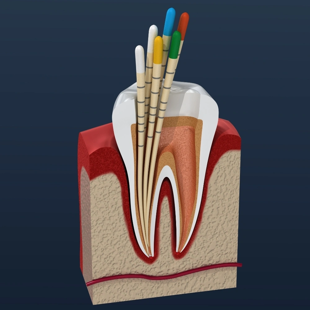 Diagram of a tooth showing root canal treatment steps with dental files at Dental Art Clinic in Cambridge.