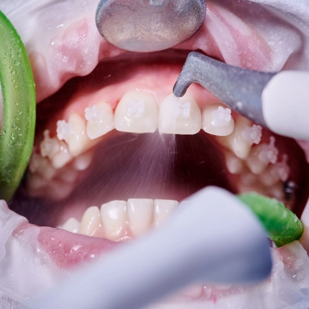 Close-up view of professional teeth cleaning around braces using a dental scaler, performed at Dental Art Clinic in Cambridge.