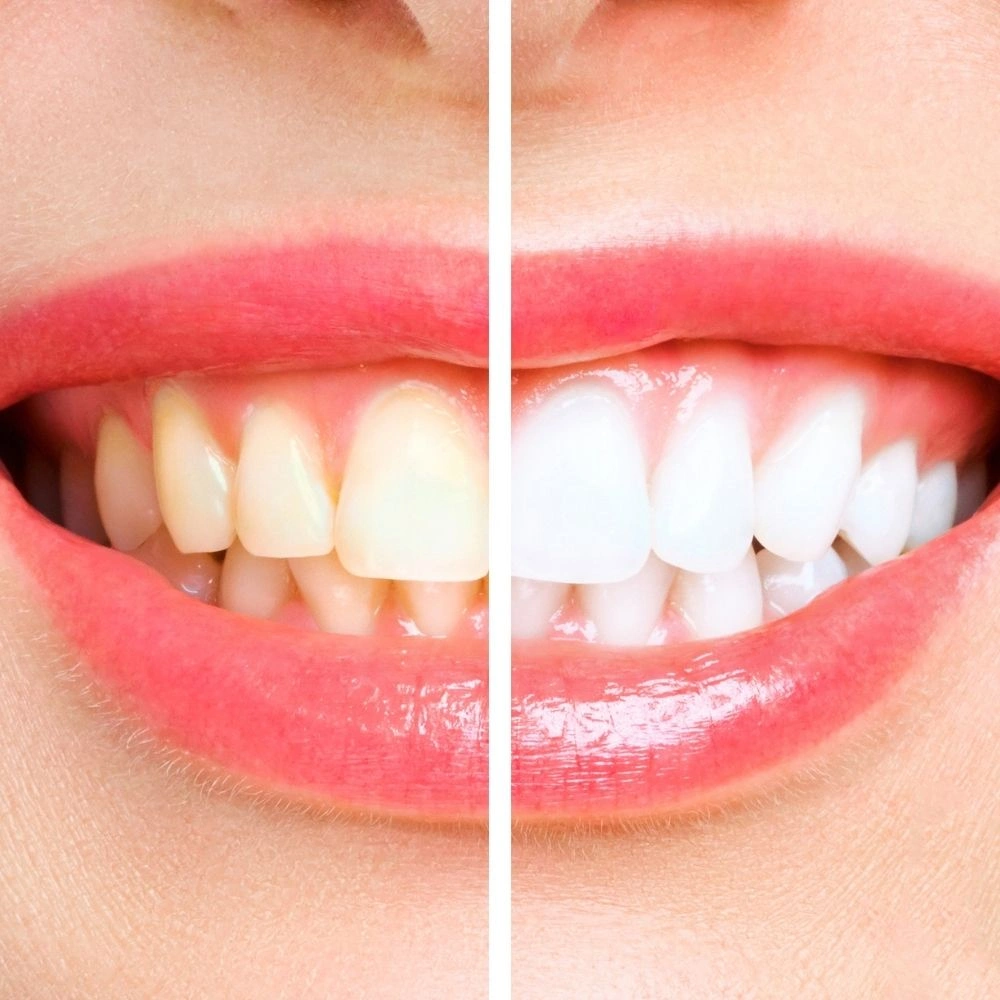 Before and after professional teeth whitening results at Dental Art Clinic in Cambridge, showing visibly brighter teeth