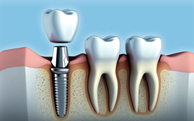 Does a Tooth Implant Hurt?