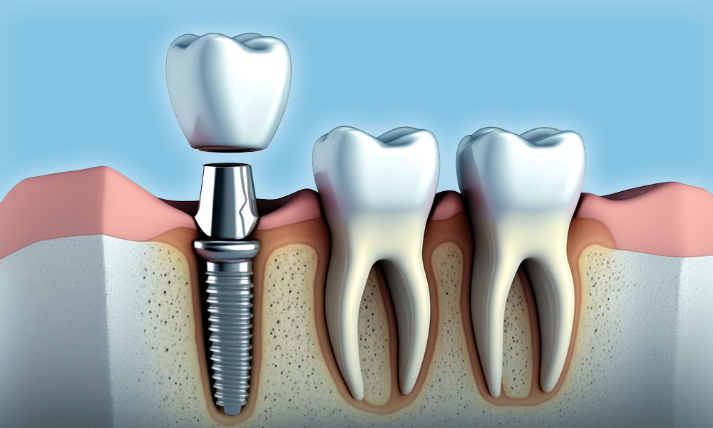 tooth implant