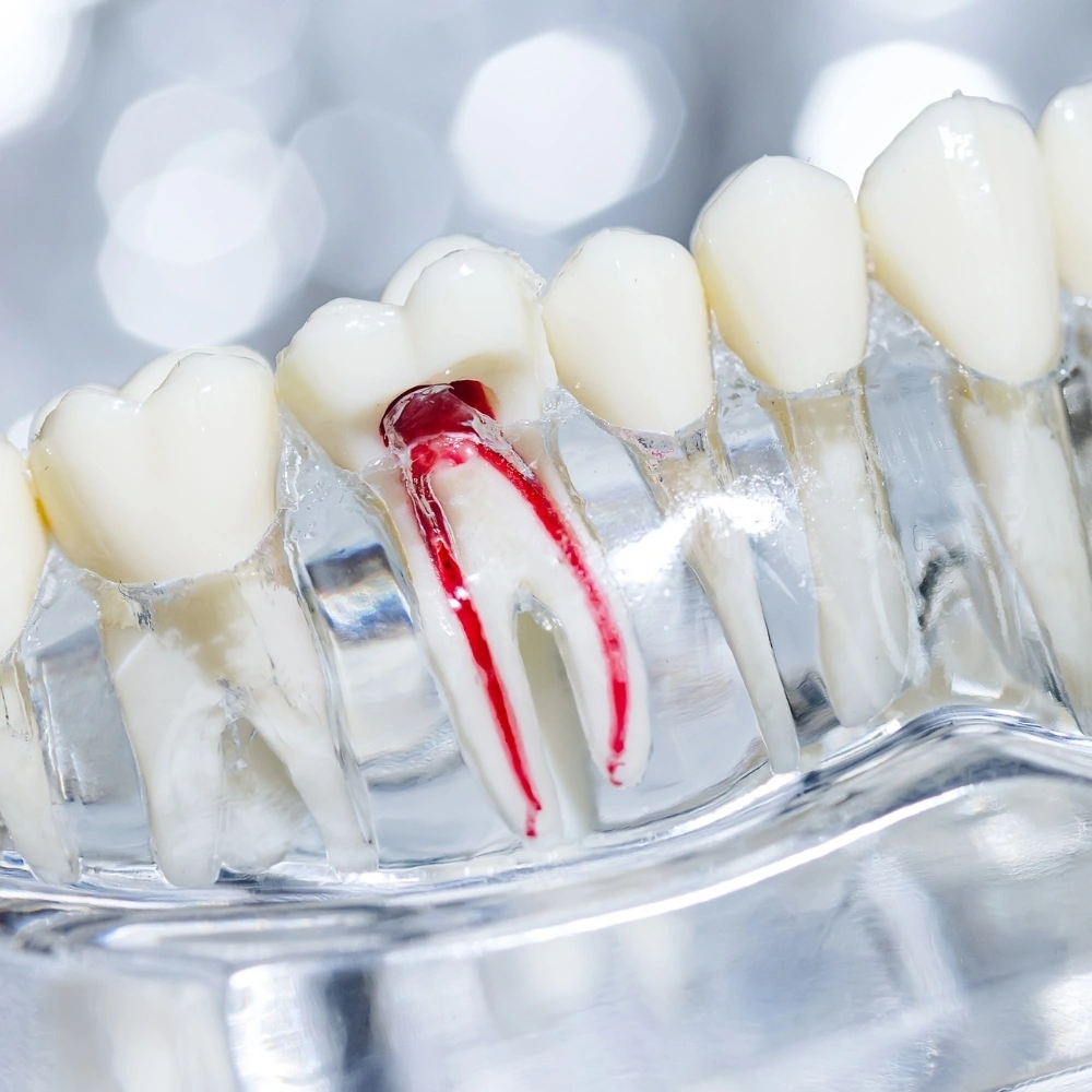 Illustration of a tooth with infected pulp highlighted in red, used to explain root canal treatment at Dental Art Clinic in Cambridge.