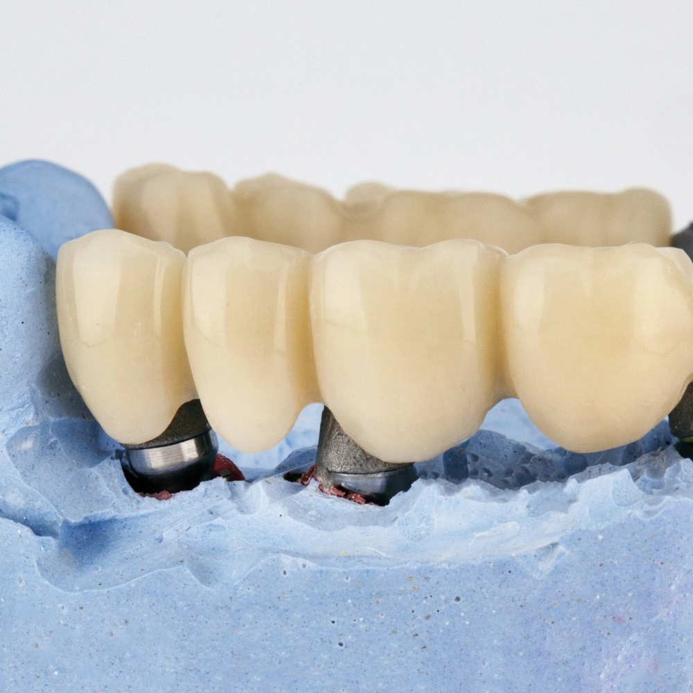 Close-up of an implant-supported dental bridge showing multiple crowns attached to dental implants at Dental Art Clinic in Cambridge.