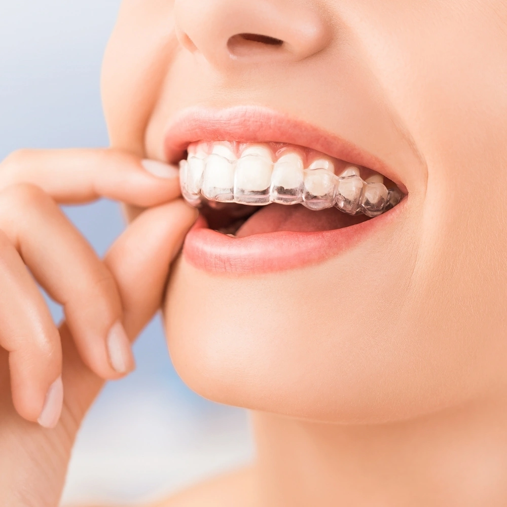 Clear aligners being worn for teeth straightening at Dental Art Clinic in Cambridge.