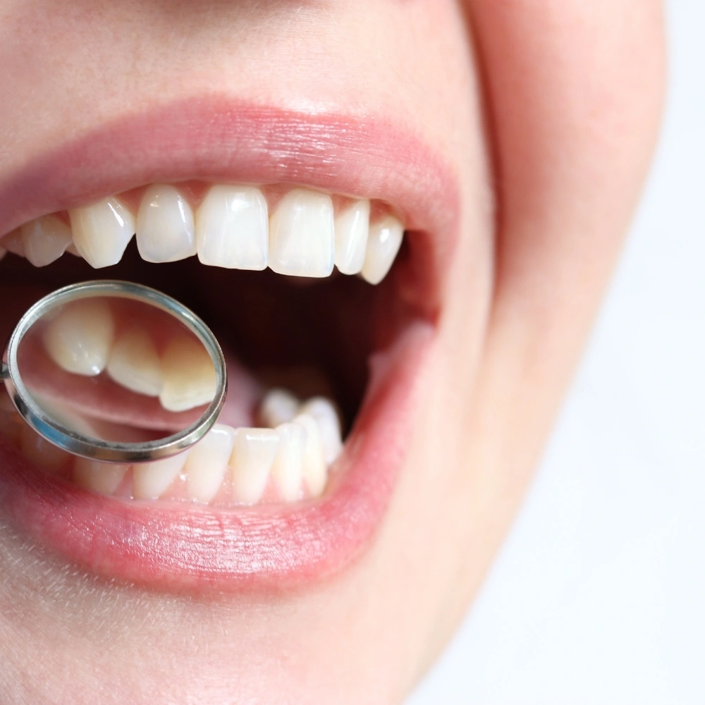 Close-up of healthy teeth being examined with a dental mirror at Dental Art Clinic in Cambridge.
